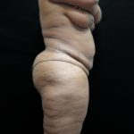 Tummy Tuck Before & After Patient #3267