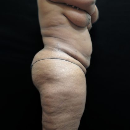 Tummy Tuck Before & After Patient #3267