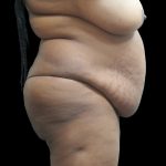 Tummy Tuck Before & After Patient #3279