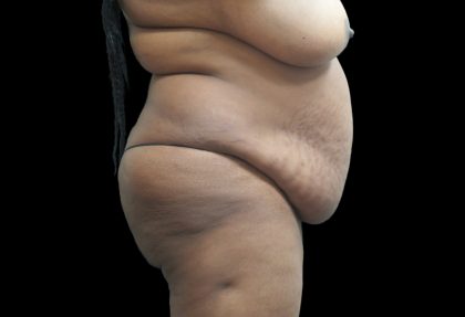 Tummy Tuck Before & After Patient #3279