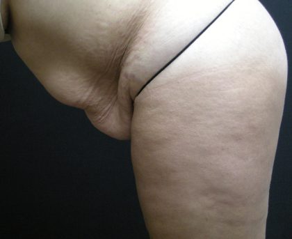 Tummy Tuck Before & After Patient #3286