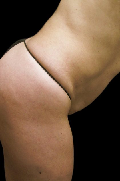 Tummy Tuck Before & After Patient #3293