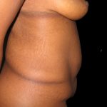 Tummy Tuck Before & After Patient #3305