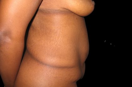 Tummy Tuck Before & After Patient #3305