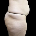 Tummy Tuck Before & After Patient #3312