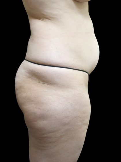 Tummy Tuck Before & After Patient #3312