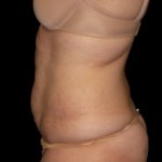 Tummy Tuck Before & After Patient #3321