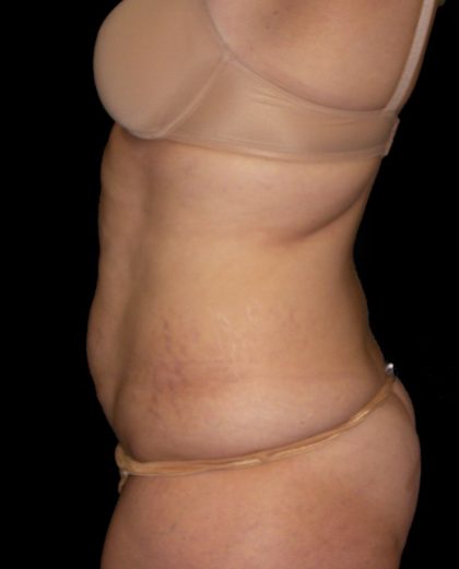 Tummy Tuck Before & After Patient #3321