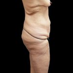 Tummy Tuck Before & After Patient #3326