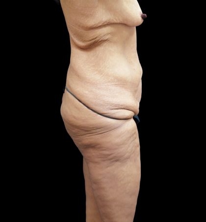 Tummy Tuck Before & After Patient #3326