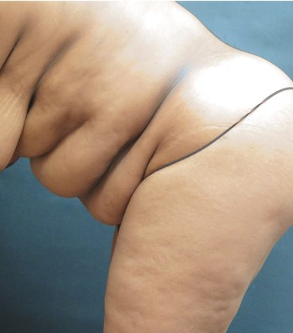 Tummy Tuck Before & After Patient #3333