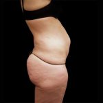 Tummy Tuck Before & After Patient #3357
