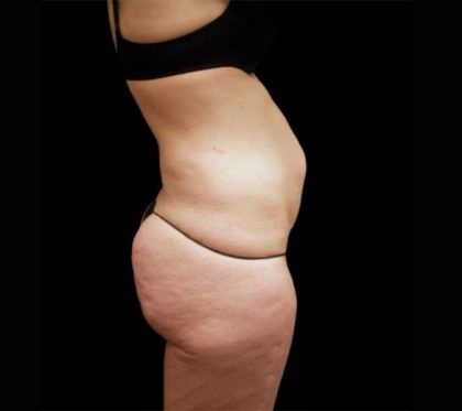 Tummy Tuck Before & After Patient #3357