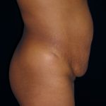 Tummy Tuck Before & After Patient #3366