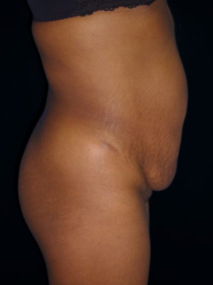 Tummy Tuck Before & After Patient #3366