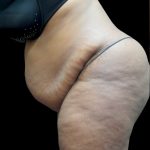 Tummy Tuck Before & After Patient #3380