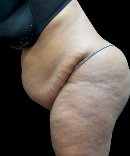 Tummy Tuck Before & After Patient #3380