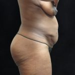 Tummy Tuck Before & After Patient #3387