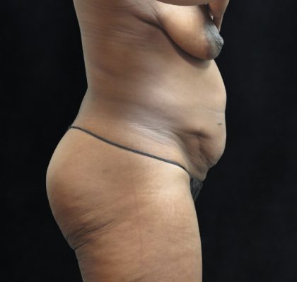 Tummy Tuck Before & After Patient #3387