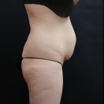 Tummy Tuck Before & After Patient #3396