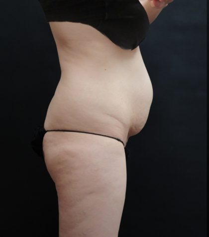 Tummy Tuck Before & After Patient #3396
