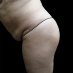 Tummy Tuck Before & After Patient #3403