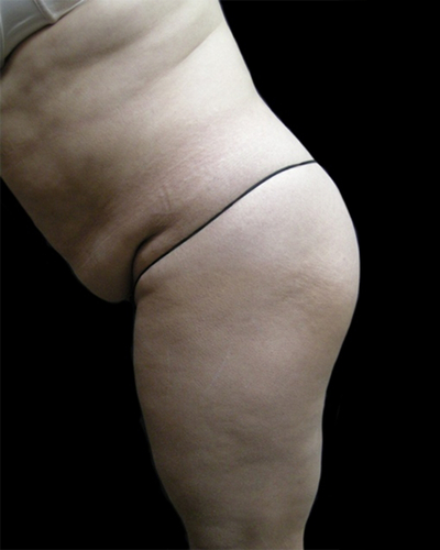 Tummy Tuck Before & After Patient #3403