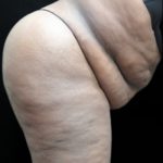 Tummy Tuck Before & After Patient #3412