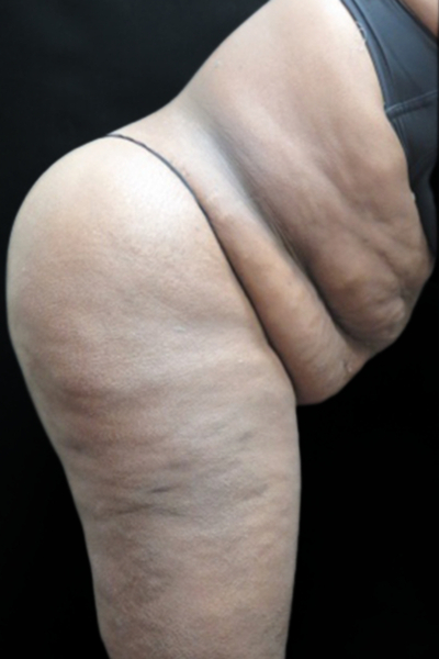 Tummy Tuck Before & After Patient #3412