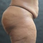 Tummy Tuck Before & After Patient #3419