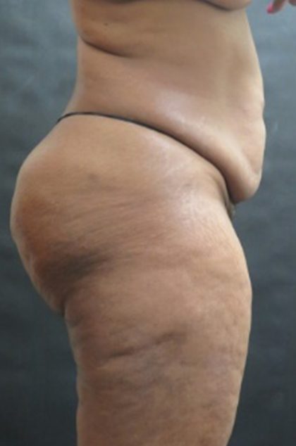 Tummy Tuck Before & After Patient #3419
