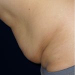 Tummy Tuck Before & After Patient #3426