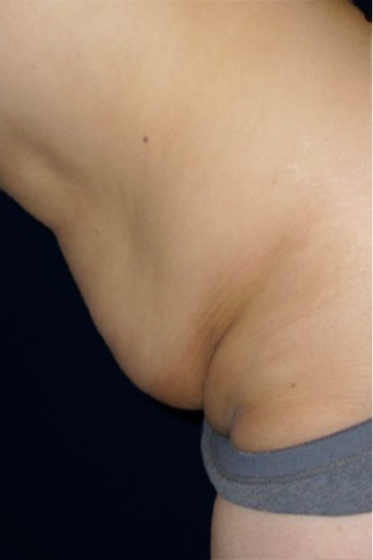 Tummy Tuck Before & After Patient #3426