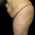 Tummy Tuck Before & After Patient #3433