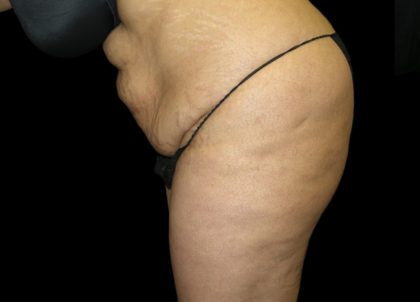 Tummy Tuck Before & After Patient #3433
