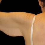 Arm Lift Before & After Patient #913
