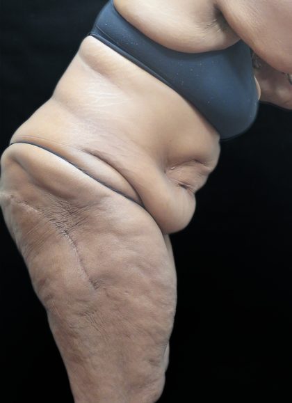 Tummy Tuck Before & After Patient #3352