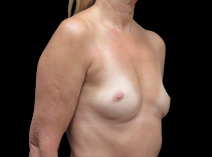 Breast Augmentation Before & After Patient #1129