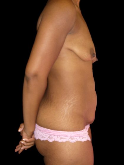 Mommy Makeover Before & After Patient #2411