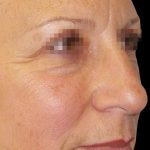 Browlift Before & After Patient #1466