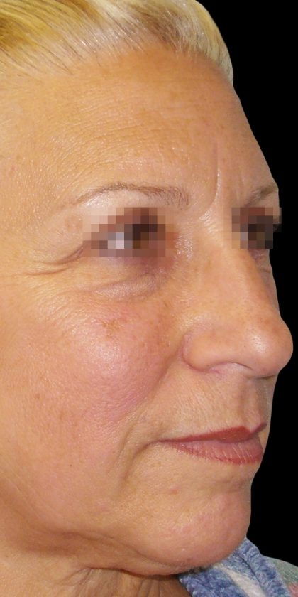 Browlift Before & After Patient #1466