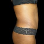 Mommy Makeover Before & After Patient #2442