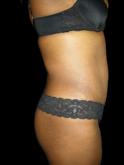 Mommy Makeover Before & After Patient #2442