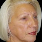 Browlift Before & After Patient #1461