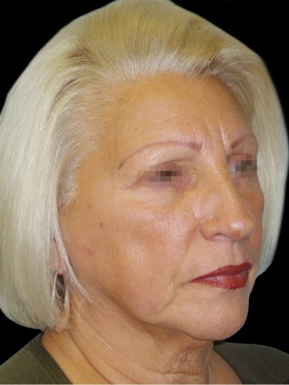 Browlift Before & After Patient #1461