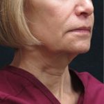 Levinelift Before & After Patient #2008