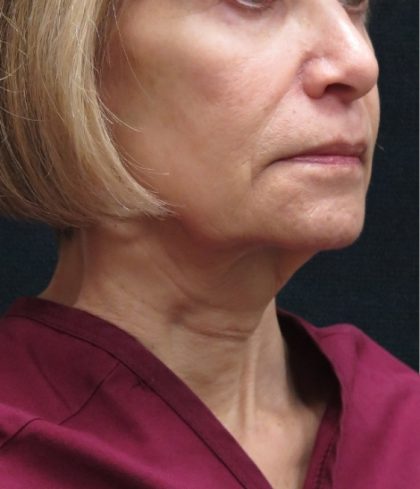 Levinelift Before & After Patient #2008