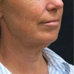 Levinelift Before & After Patient #1999