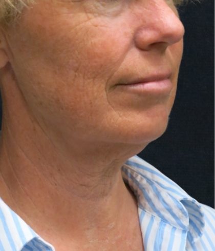 Levinelift Before & After Patient #1999