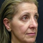 Levinelift Before & After Patient #1988